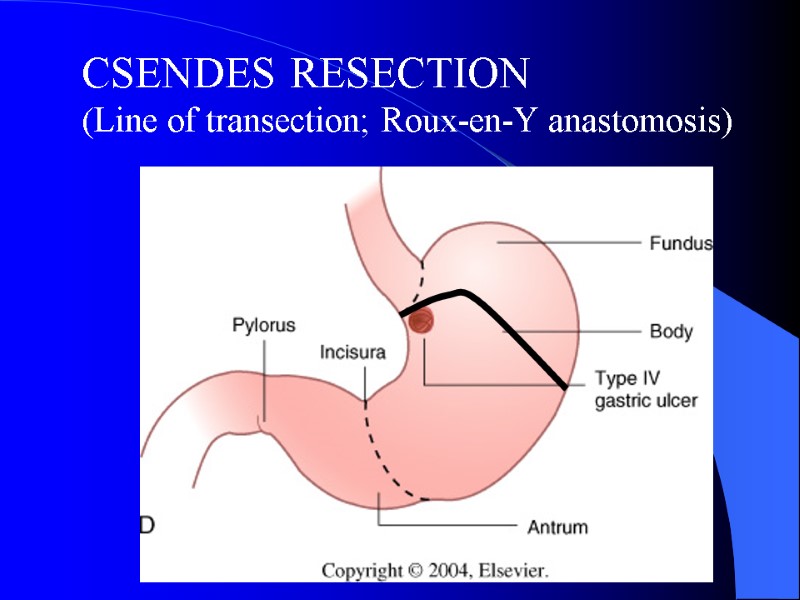 CSENDES RESECTION  (Line of transection; Roux-en-Y anastomosis)